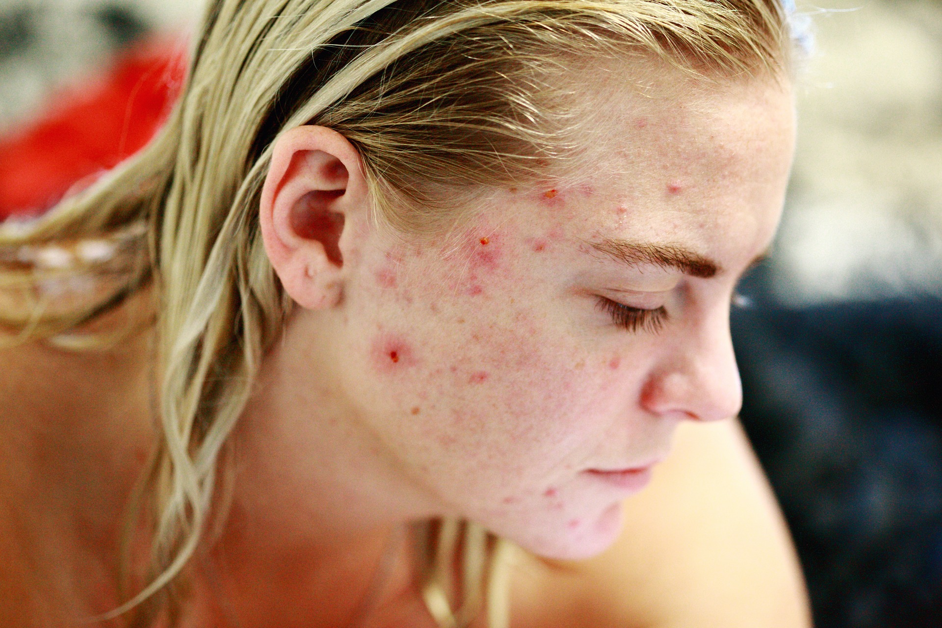 Common Acne Treatment In Adolescents Can Have Long-Term Effects On Skeletal System: Study