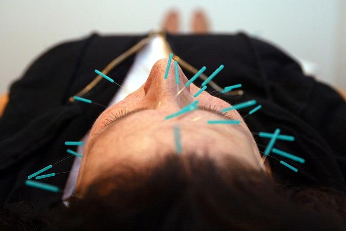 l'acupuncture