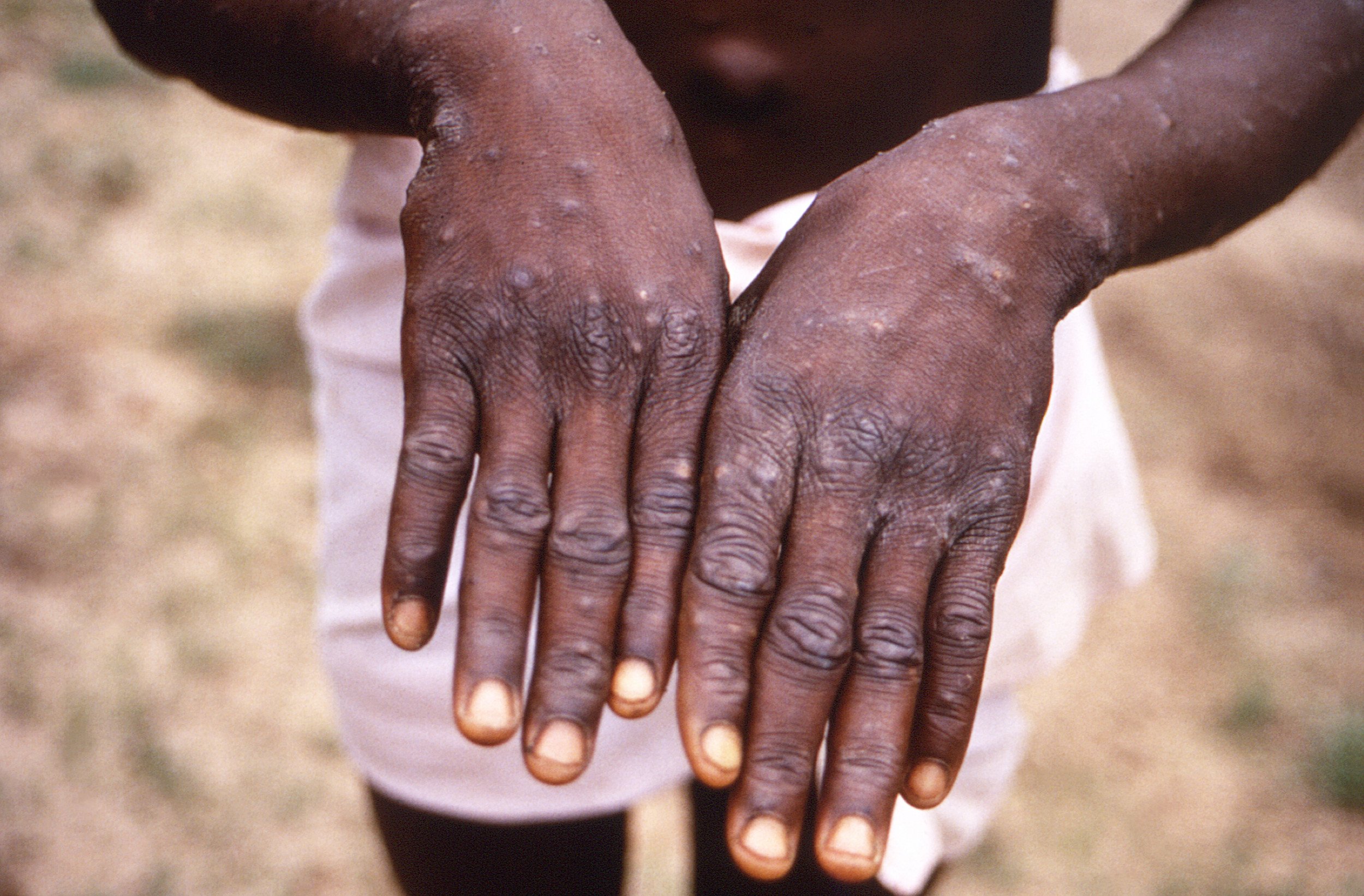 Plus de cas de Mpox signalés à New York et dans d'autres États au milieu d'une éventuelle résurgence